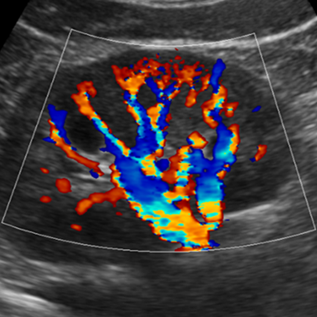 5._Kidney_Color_Flow