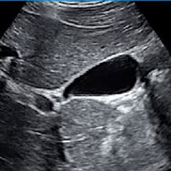 Abdomen - Gallbladder Protocol