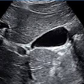 Abdomen - Gallbladder Protocol