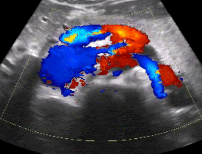 Abdominal ultrasound window with color flow Doppler, ultrasound of the abdomen training