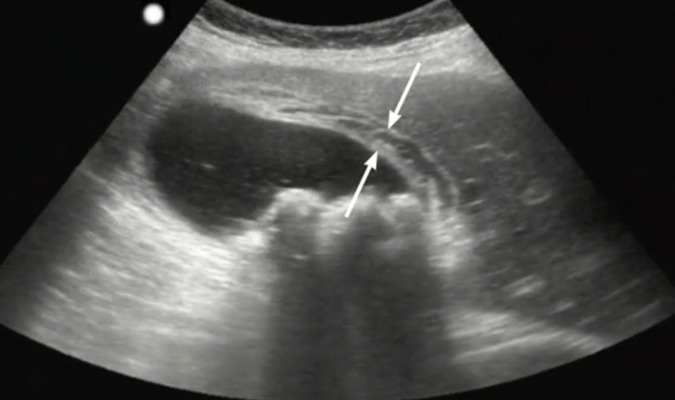 Point of care ultrasound scan of acute cholecystitis