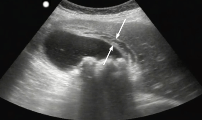 Point of care ultrasound scan of acute cholecystitis Point of care ultrasound scan of acute cholecystitis