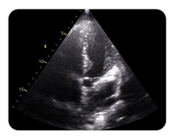 Ultrasound sound image of the heart showing SonoSim's echocardiography cases for DMS on demand