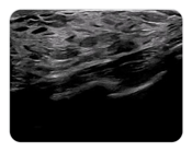 Ultrasound image of SonoSim's breast ultrasound content