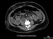 CT-Abdomen-Axial-Slice400x300