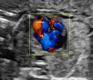 Ultrasound view of the heart with color flow Doppler, highlighting echocardiography methods in cardiac sonography programs online