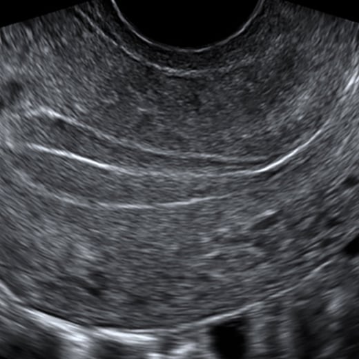 DMSGYN_Uterus