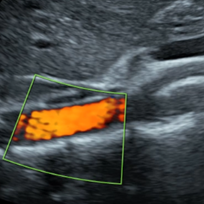 DMS_Abdominal_Aorta