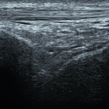 DMS_Anterior_Ankle