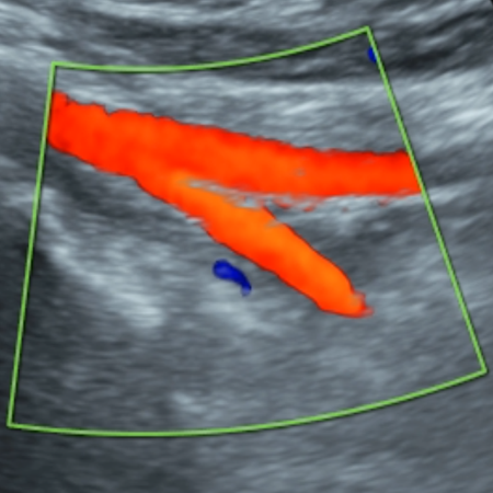 DMS_Aortic_Iliac_Artery