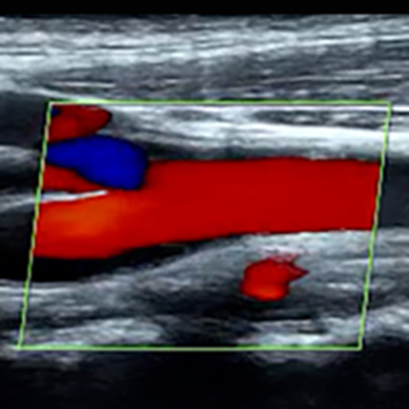DMS_ExtracranialCerebrovascular