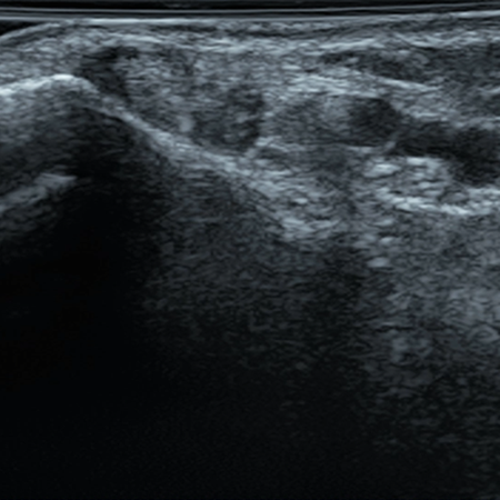 DMS_Medial_Ankle