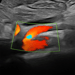 DMS Mesenteric Artery Protocol