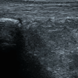 DMS_Posterior_Ankle