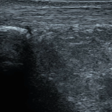 DMS_Posterior_Ankle