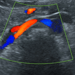 DMS Renal Artery Protocol