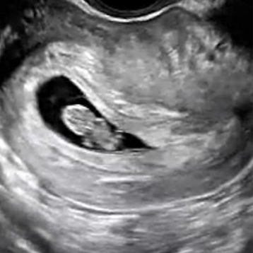 DMS_Standard_First_Trimester_Protocol