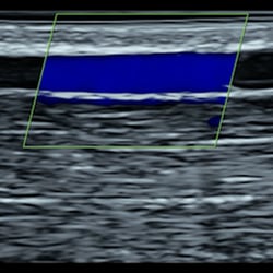 DMS Upper Extremity Venous Protocol