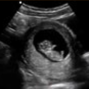 First time pregnanacy-1
