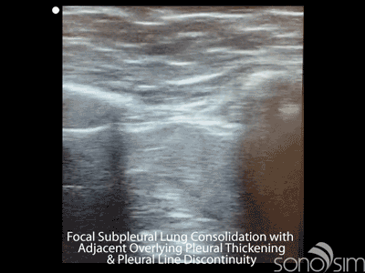 Focal-Subpleural-Consolidation-with-Adjacent-Overlying-Pleural-Thickening-Pleural-Line-Discontinuity