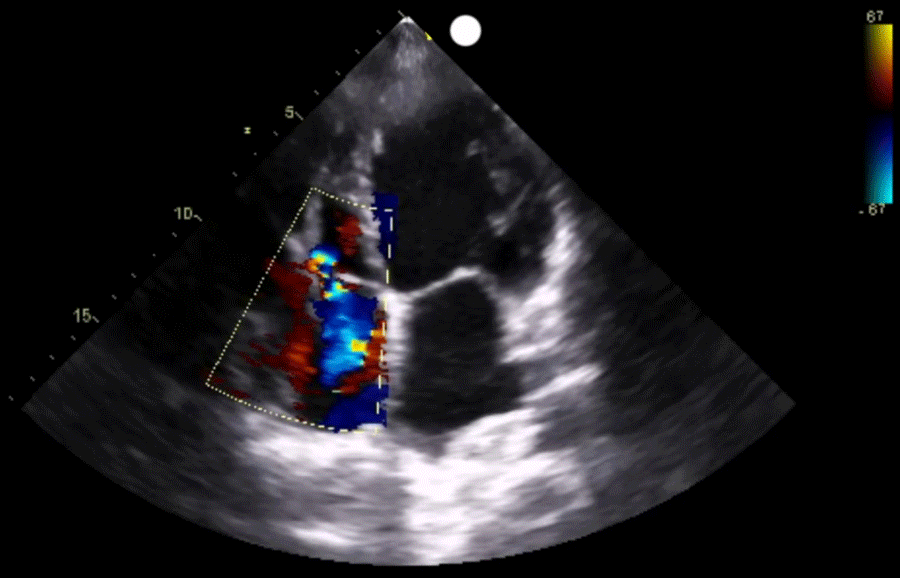 Ultrasound showing all four chambers of the heart with color flow Doppler in cardiac sonography training