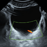 Genitourinary - Bladder Protocol
