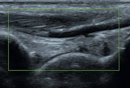 Color doppler ultrasound image of blood vessel Color doppler ultrasound image of blood vessel