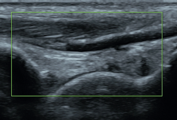 A vascular scan showing a key application for POC ultrasound learners