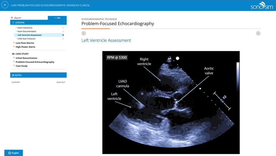 Left Ventricle Assessment in LAVD Problem-Focused Echocardiography with SonoSim's advanced clinical cardiac sonography case Left Ventricle Assessment in LAVD Problem-Focused Echocardiography with SonoSim's advanced clinical cardiac sonography case