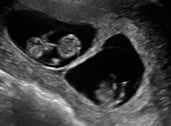OBGYN ultrasound image