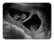 Obstetric ultrasound image to represent SonoSim modules that cover obstetrics and gynecology for DMS