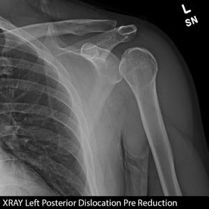P1080_Lt_Shoulder_XRAY