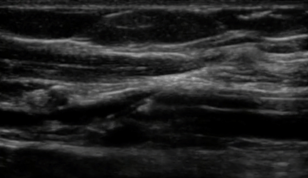 Peripheral venous access ultrasound scan allowing from quality improvement in healthcare