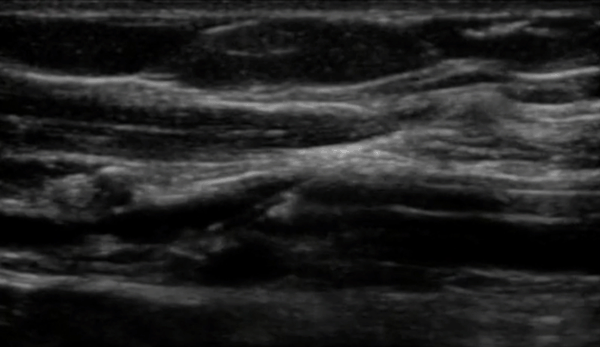 Peripheral venous access ultrasound scan allowing from quality improvement in healthcare Peripheral venous access ultrasound scan allowing from quality improvement in healthcare