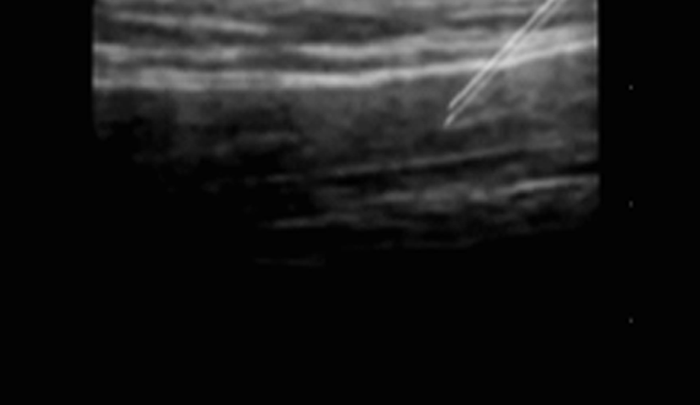 Ultrasound-guided procedure footage