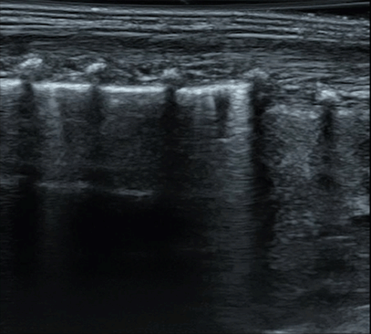 Footage of a lung ultrasound 