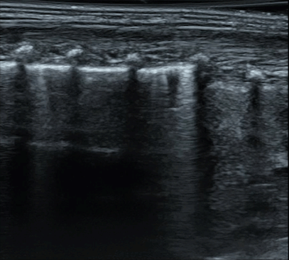 Footage of a lung ultrasound Footage of a lung ultrasound