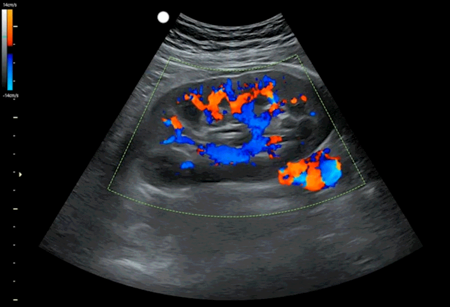 Color doppler ultrasound footage in SonoSim vascular ultrasound training