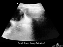Small-Bowel-Long-Axis-View400x300