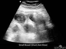 Small-Bowel-Short-Axis-View400x300