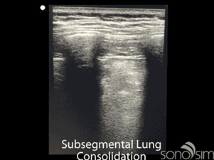 Subsegmental-Lung-Consolidation