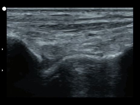 Tibiotalar MSK ultrasound footage