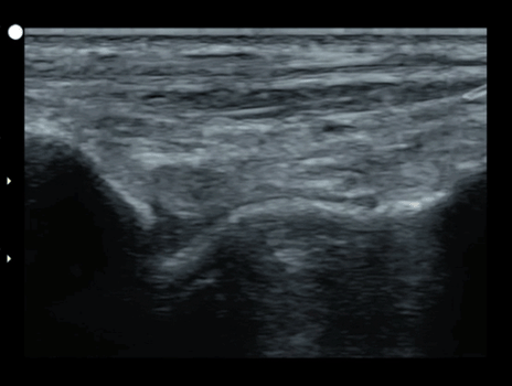 Tibiotalar MSK ultrasound footage Tibiotalar MSK ultrasound footage