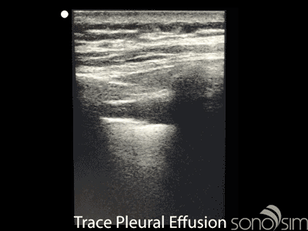 Trace-Pleural-Effusion