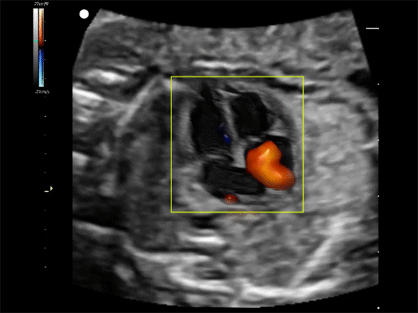 3D ultrasound footage of the heart