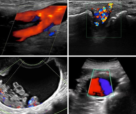 Four different color doppler ultrasound scans depicting SonoSim's efforts toward quality measures in healthcare Four different color doppler ultrasound scans depicting SonoSim's efforts toward quality measures in healthcare