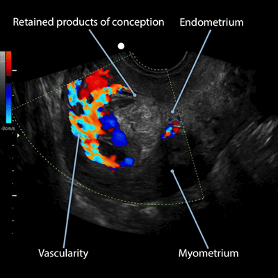 abnormuterus2_conception_doppler_7