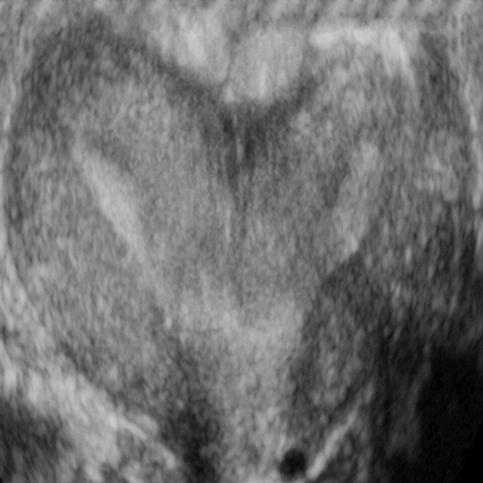 adv_abnormal_uterus1_ultrasound__26828
