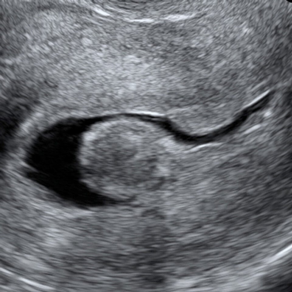 adv_abnormal_uterus2_ultrasound__79600
