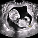 Image of a First-Trimester Pregnancy ultrasound, part of SonoSim's Advanced Clinical Series in ultrasound training